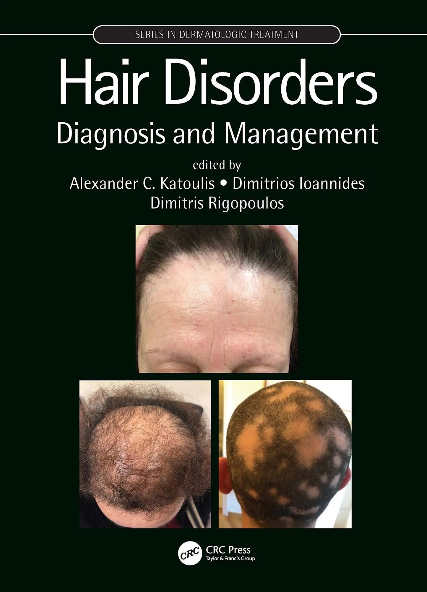 Hair Disorders Diagnosis and Management by Alexander C. Katoulis – book cover
