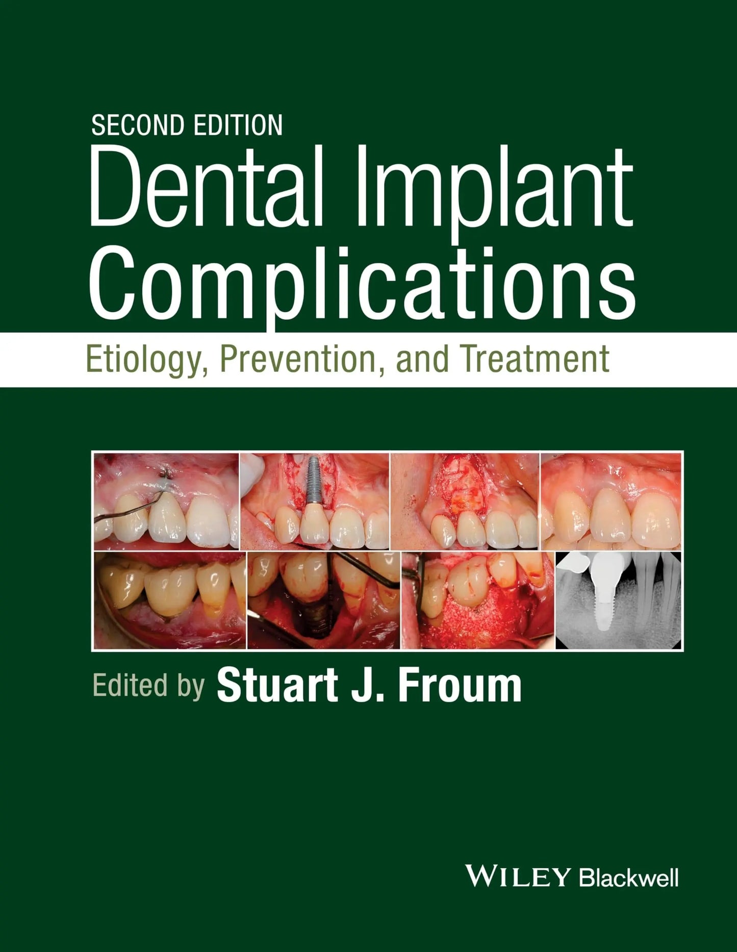 Dental Implant Complications Etiology, Prevention, and Treatment by Stuart J. Froum – book cover