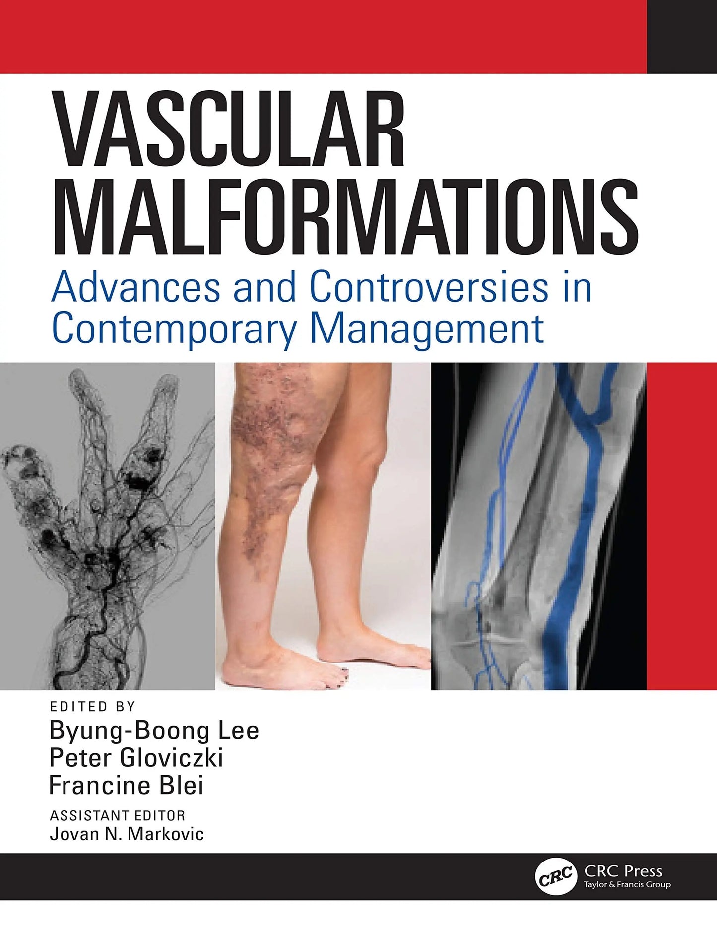 Vascular Malformations Advances and Controversies in Contemporary Management by Byung Boong Lee – book cover