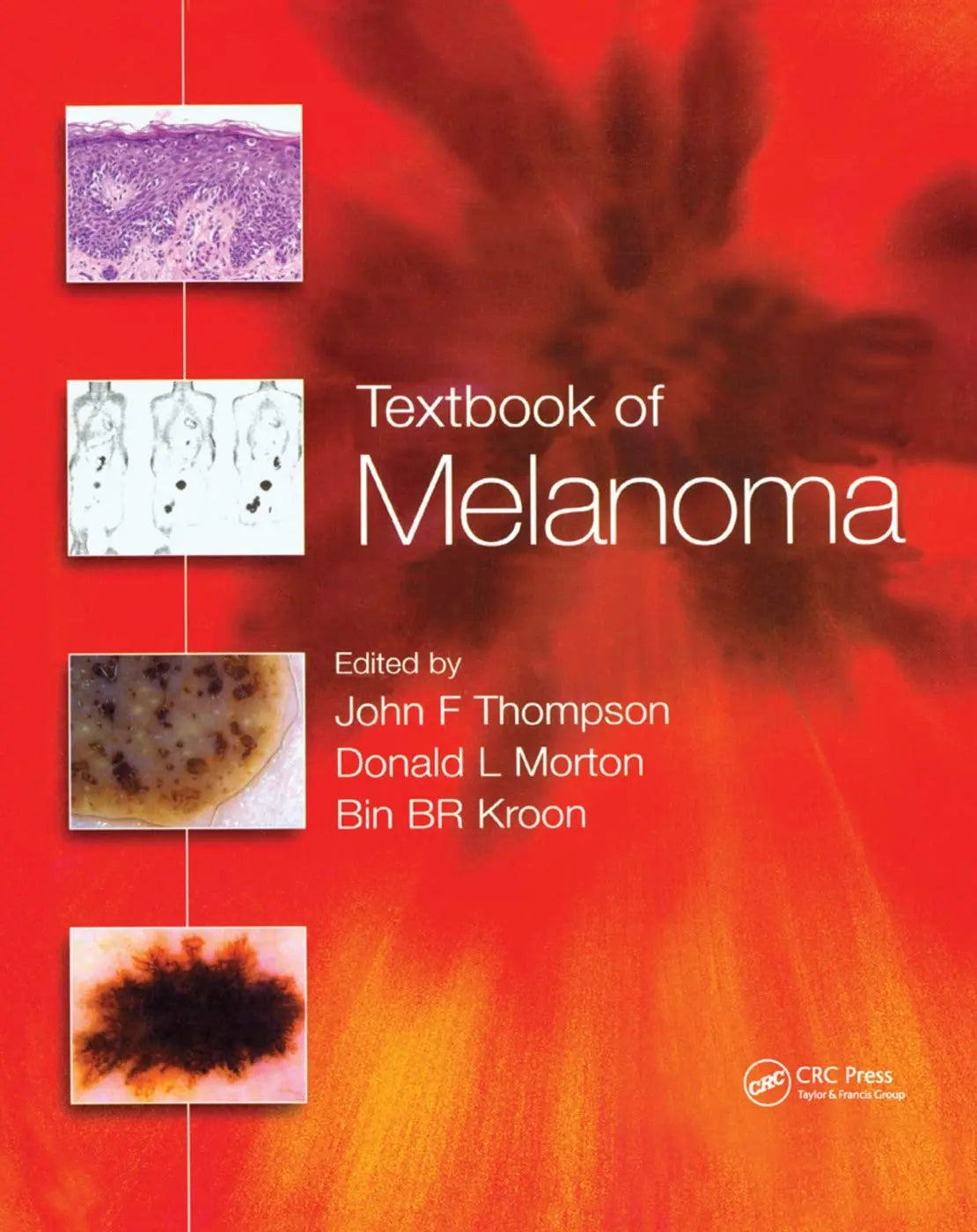 Textbook of Melanoma Pathology, Diagnosis and Management by John F. Thompson – book cover