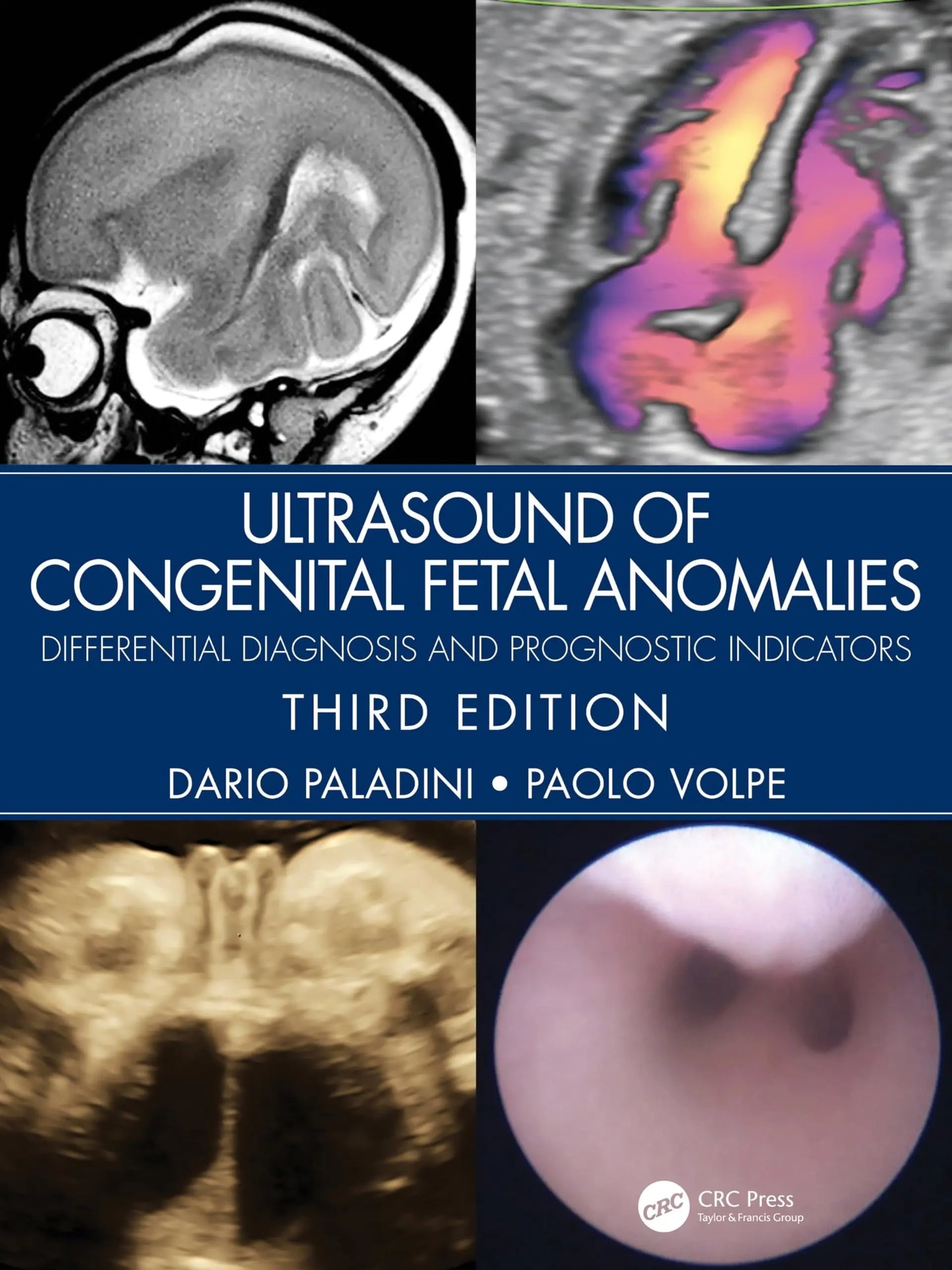 Ultrasound of Congenital Fetal Anomalies Differential Diagnosis and Prognostic Indicators by Dario Paladini – book cover
