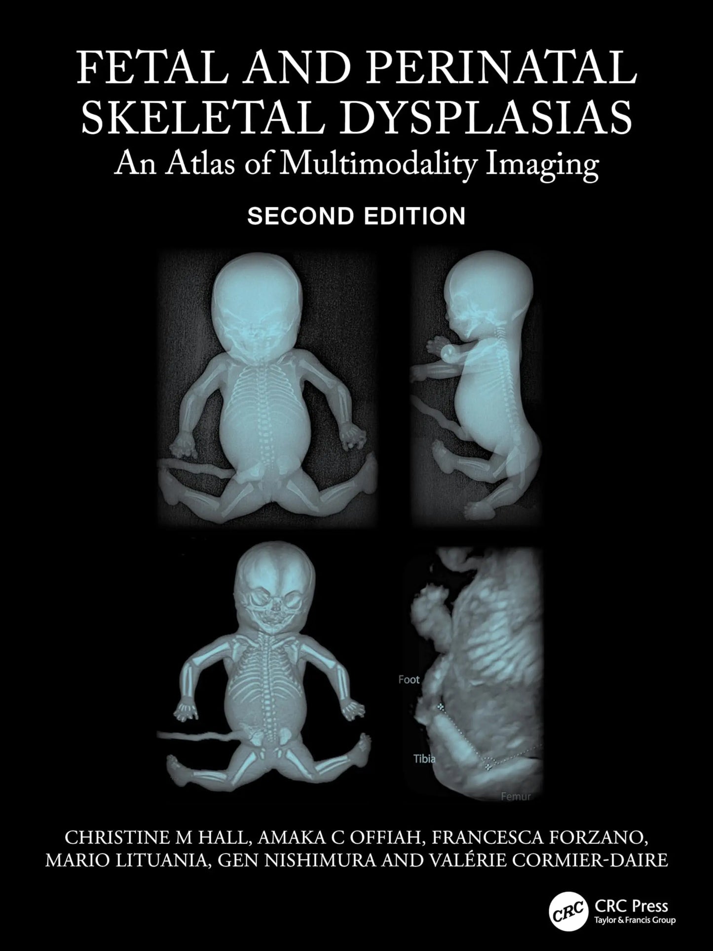 Fetal and Perinatal Skeletal Dysplasias An Atlas of Multimodality Imaging by Christine M. Hall – book cover