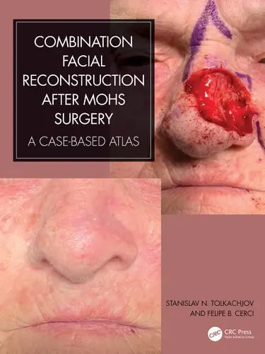 Combination Facial Reconstruction After Mohs Surgery A Case Based Atlas
