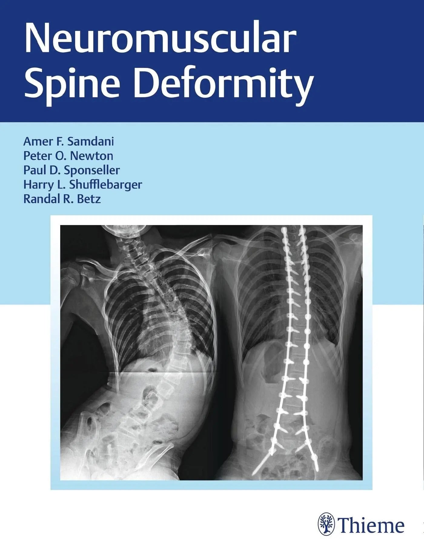 Neuromuscular Spine Deformity by Amer F. Samdani – book cover