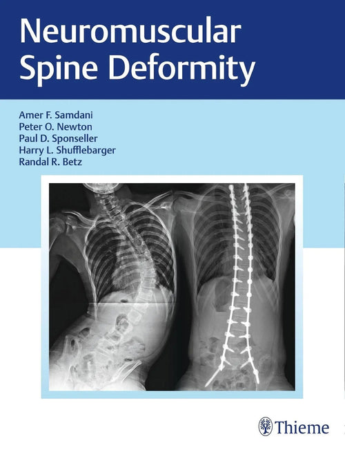Neuromuscular Spine Deformity by Amer F. Samdani