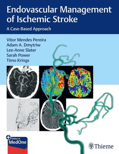 Endovascular Management of Ischemic Stroke A Case-Based Approach Thieme Medical Publishers, Incorporated