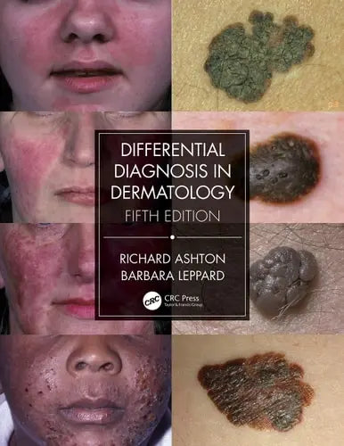 Differential Diagnosis in Dermatology CRC Press
