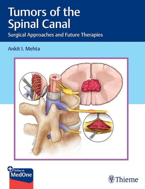 Tumors of the Spinal Canal Surgical Approaches and Future Therapies by Ankit I. Mehta